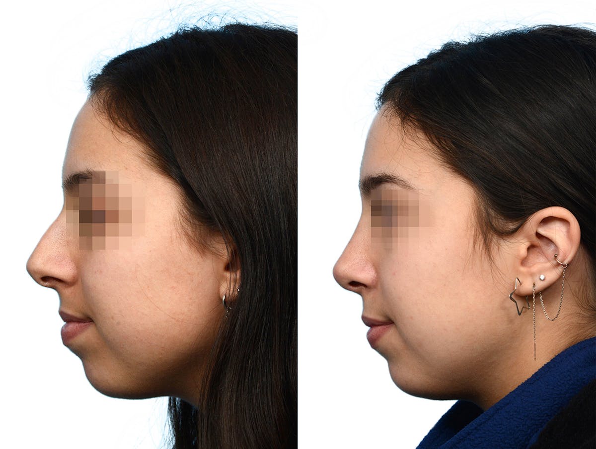 Rhinoplasty Before & After Gallery - Patient 844932 - Image 2