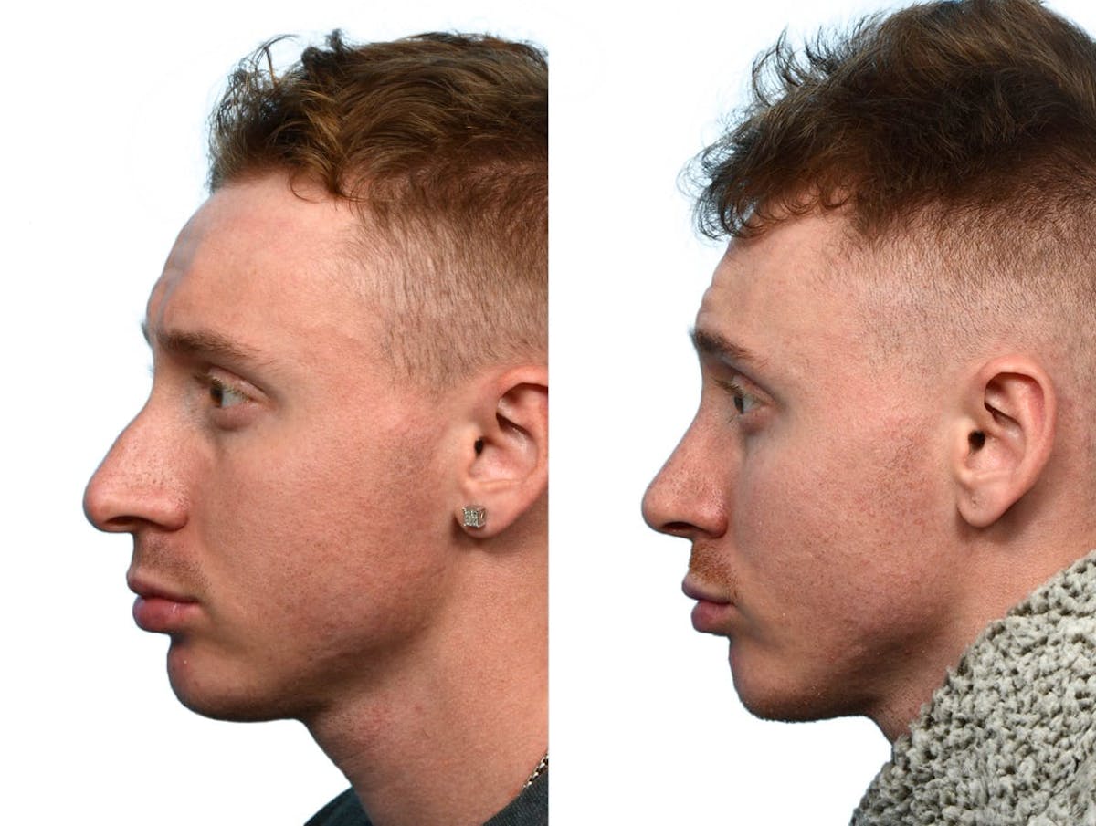 Rhinoplasty Before & After Gallery - Patient 518117 - Image 1