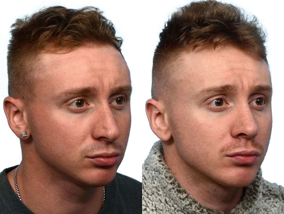 Rhinoplasty Before & After Gallery - Patient 518117 - Image 2