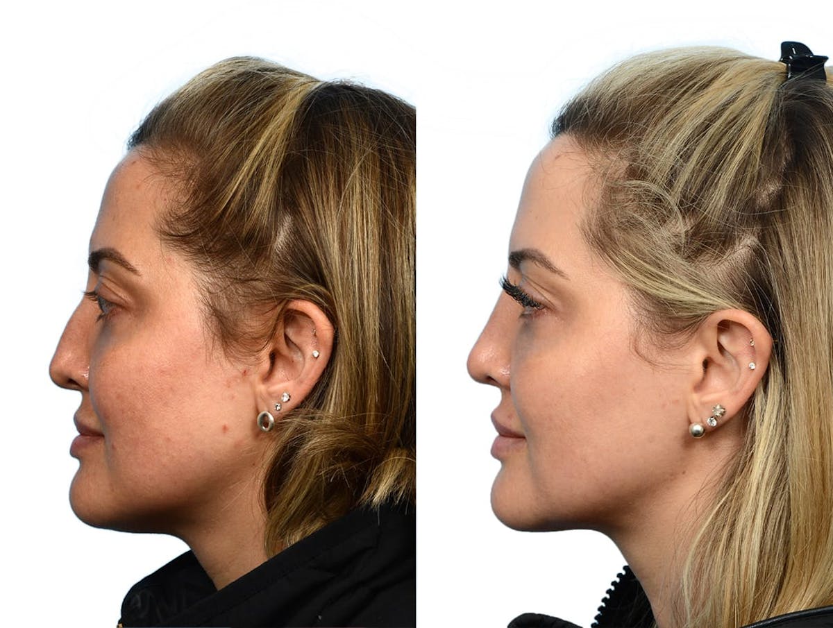 Rhinoplasty Before & After Gallery - Patient 386108 - Image 2