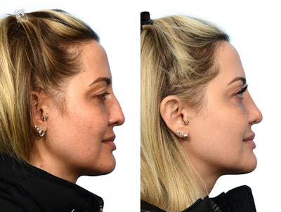 Rhinoplasty Before & After Gallery - Patient 386108 - Image 1