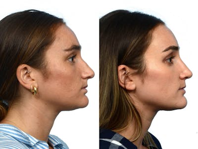 Rhinoplasty Before & After Gallery - Patient 228660 - Image 1