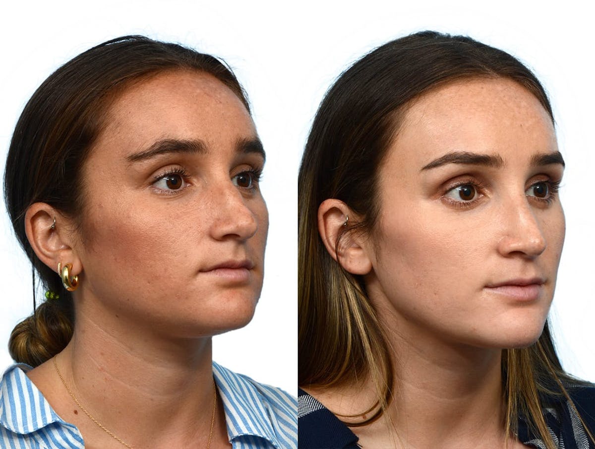 Rhinoplasty Before & After Gallery - Patient 228660 - Image 2
