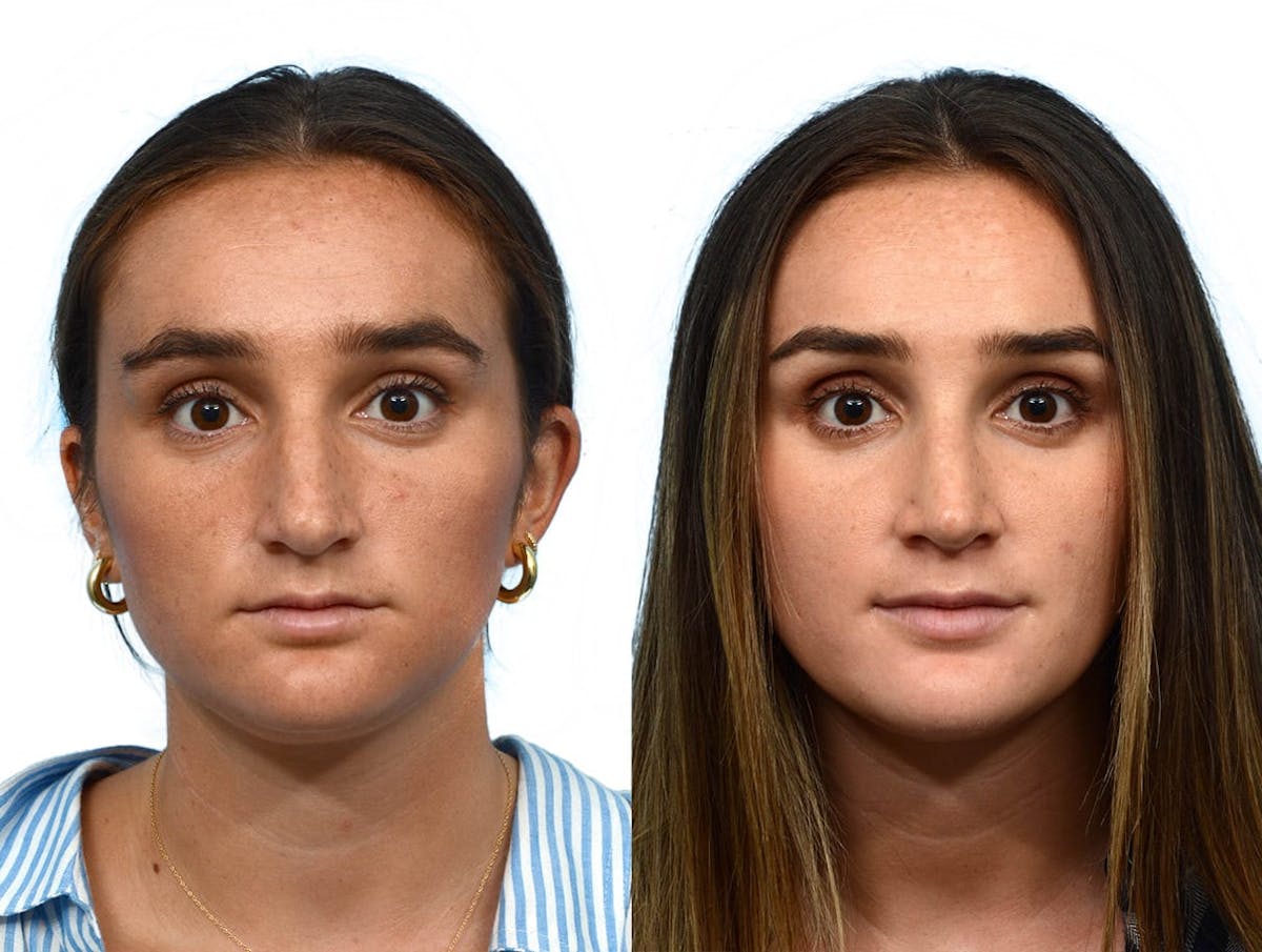 Rhinoplasty Before & After Gallery - Patient 228660 - Image 3