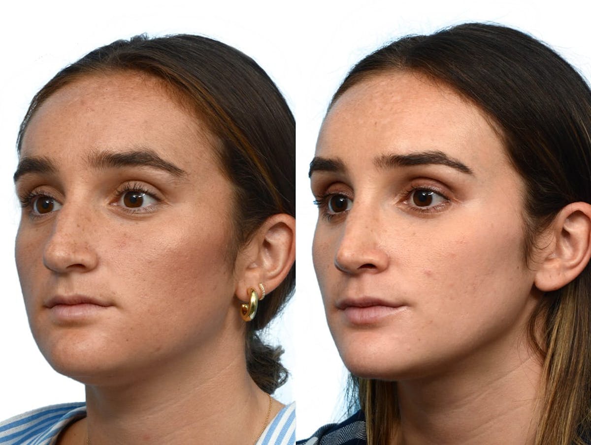 Rhinoplasty Before & After Gallery - Patient 228660 - Image 4