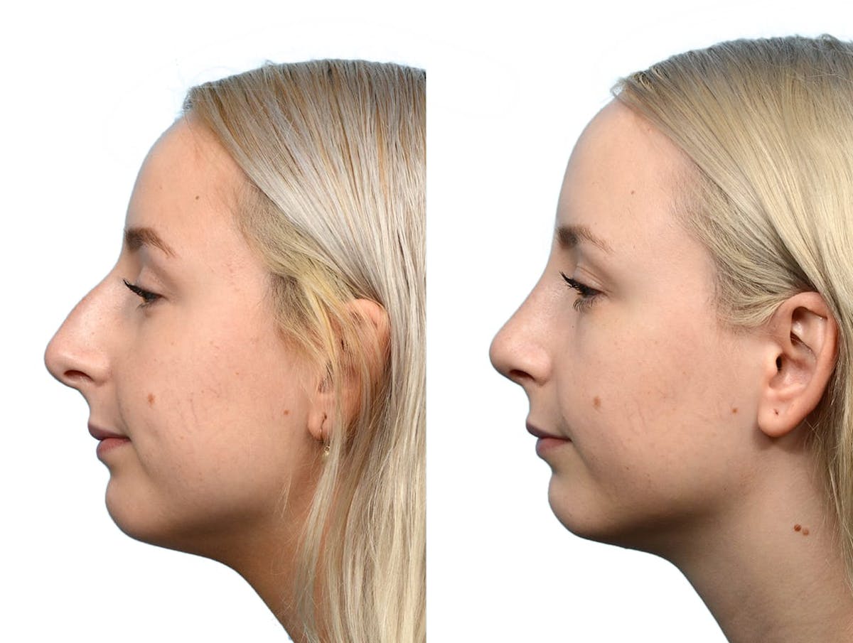 Rhinoplasty Before & After Gallery - Patient 260540 - Image 2