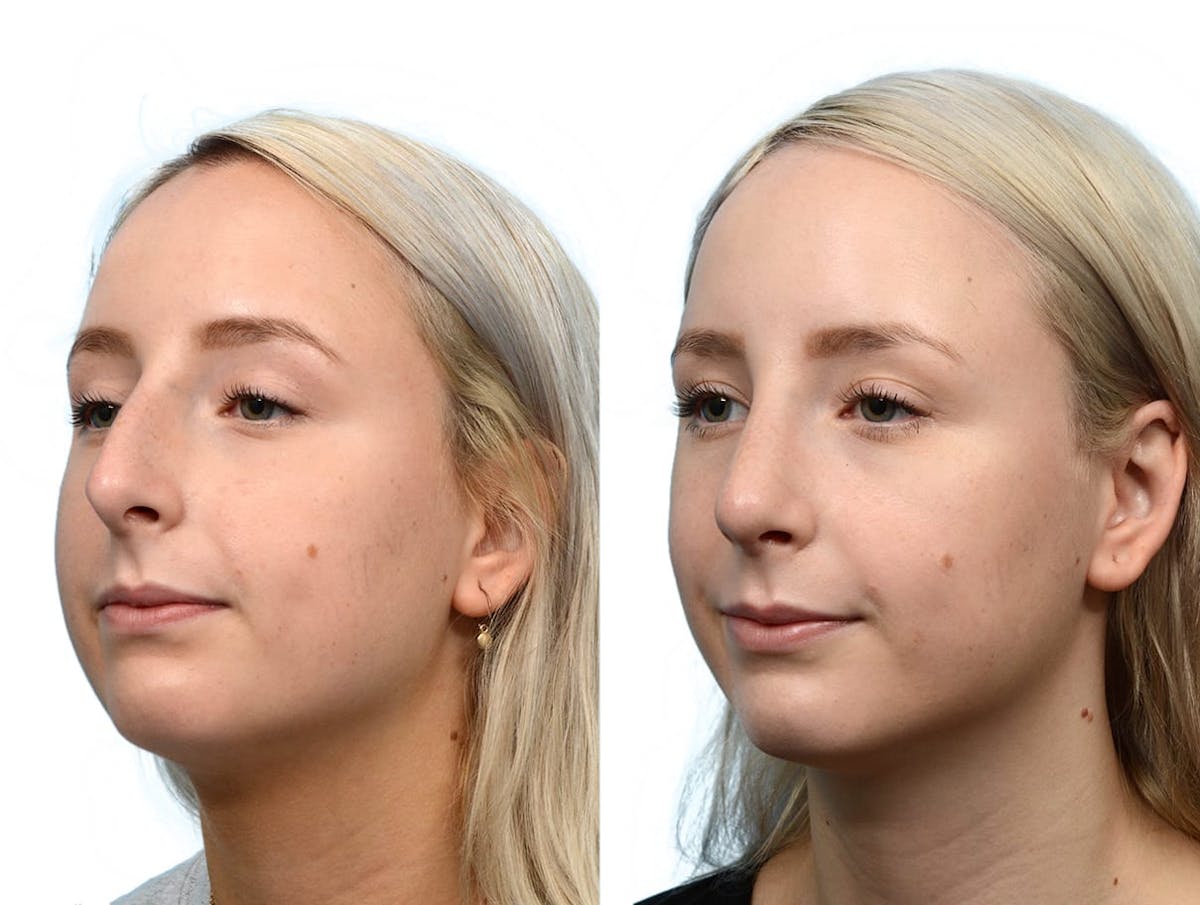Rhinoplasty Before & After Gallery - Patient 260540 - Image 3