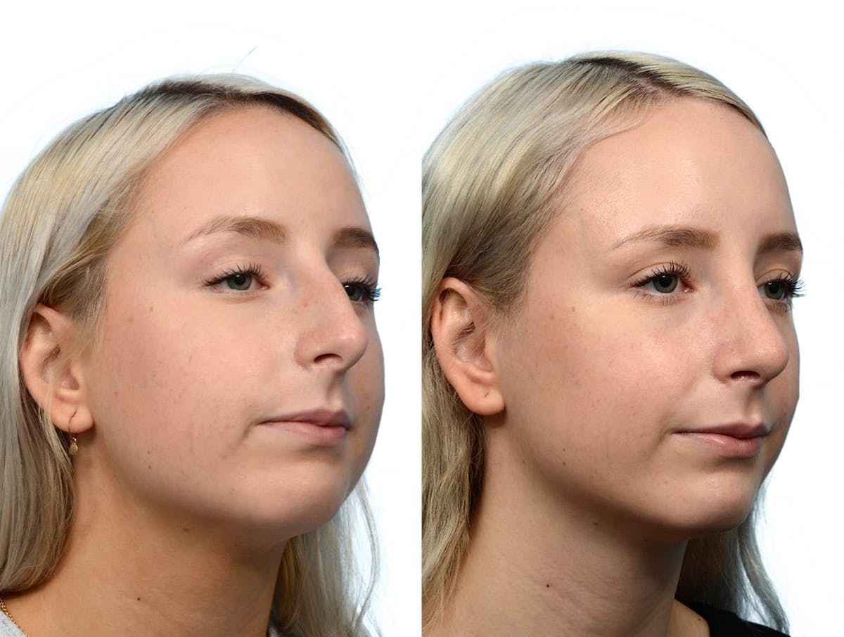 Rhinoplasty Before & After Gallery - Patient 260540 - Image 4