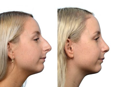 Rhinoplasty Before & After Gallery - Patient 260540 - Image 1