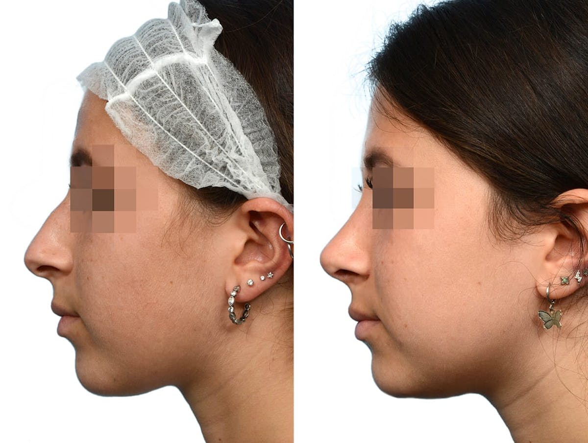 Rhinoplasty Before & After Gallery - Patient 369154 - Image 2