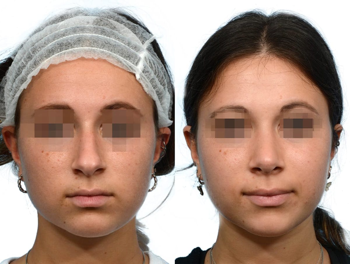 Rhinoplasty Before & After Gallery - Patient 369154 - Image 3