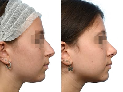 Rhinoplasty Before & After Gallery - Patient 369154 - Image 1