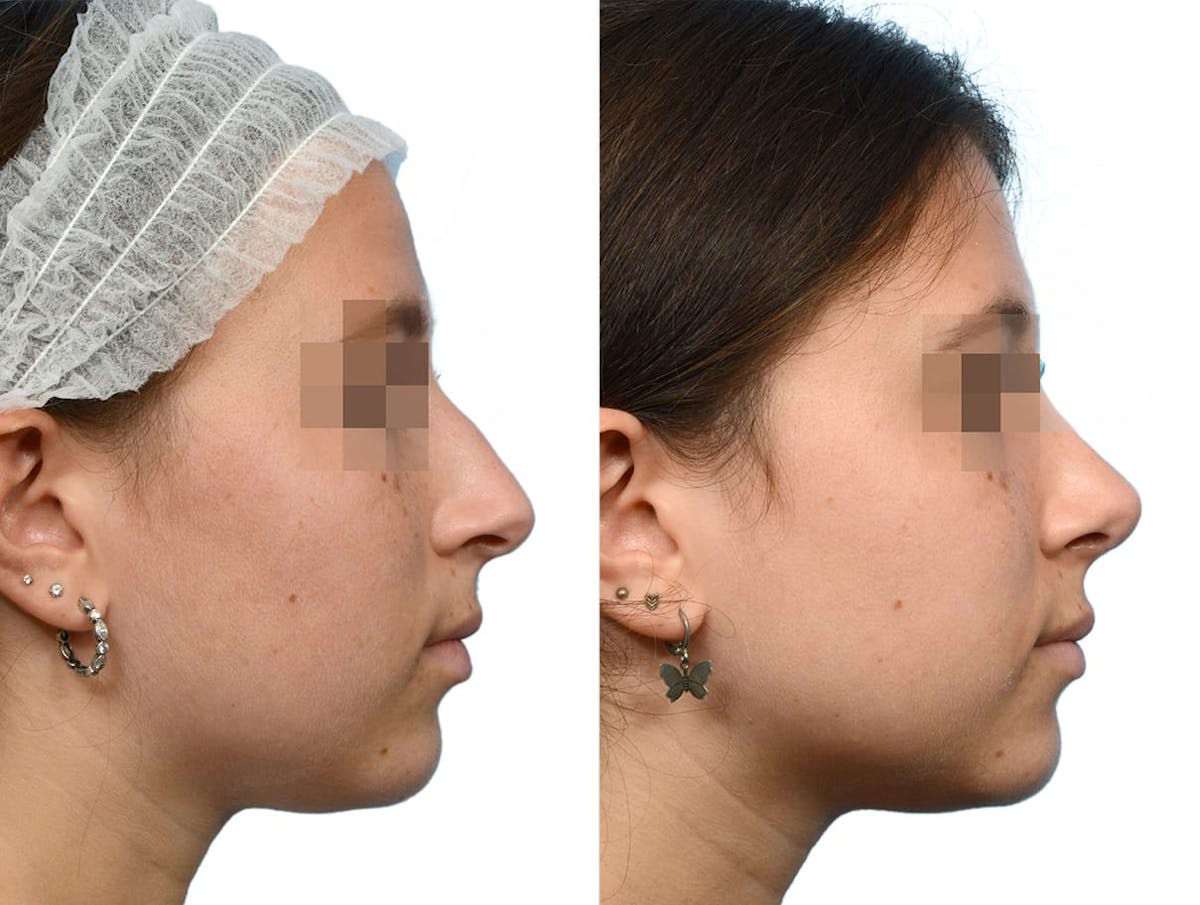 Rhinoplasty Before & After Gallery - Patient 369154 - Image 1