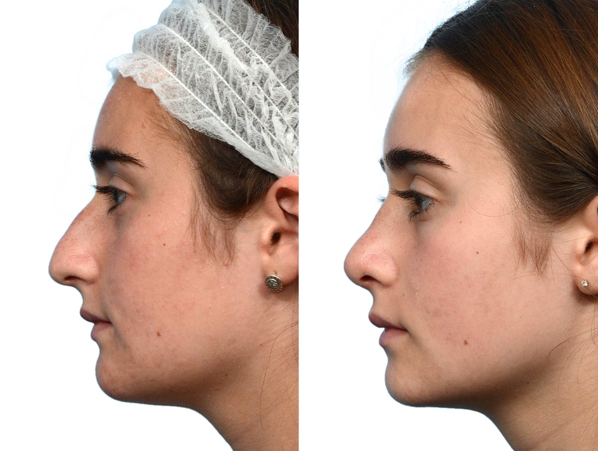 Rhinoplasty Before & After Gallery - Patient 211861 - Image 2