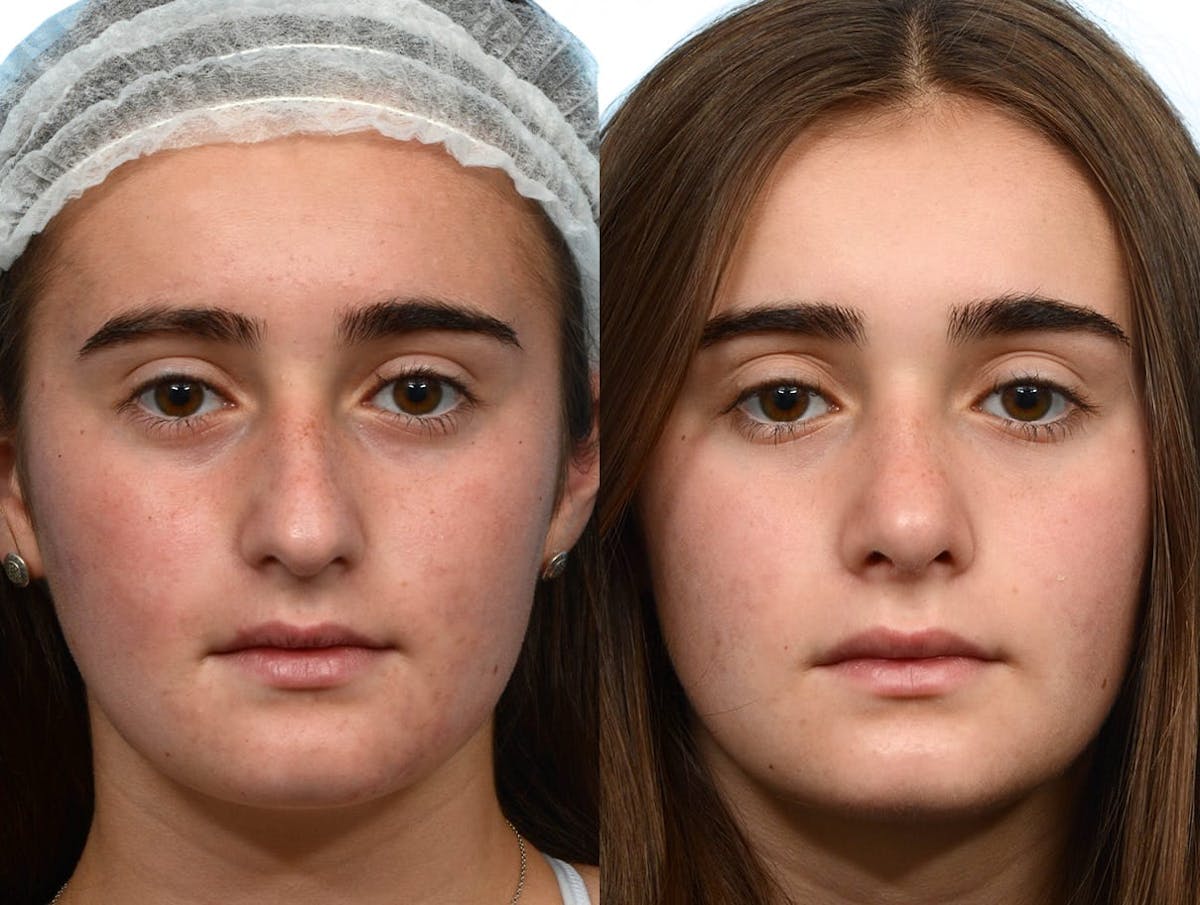 Rhinoplasty Before & After Gallery - Patient 211861 - Image 3