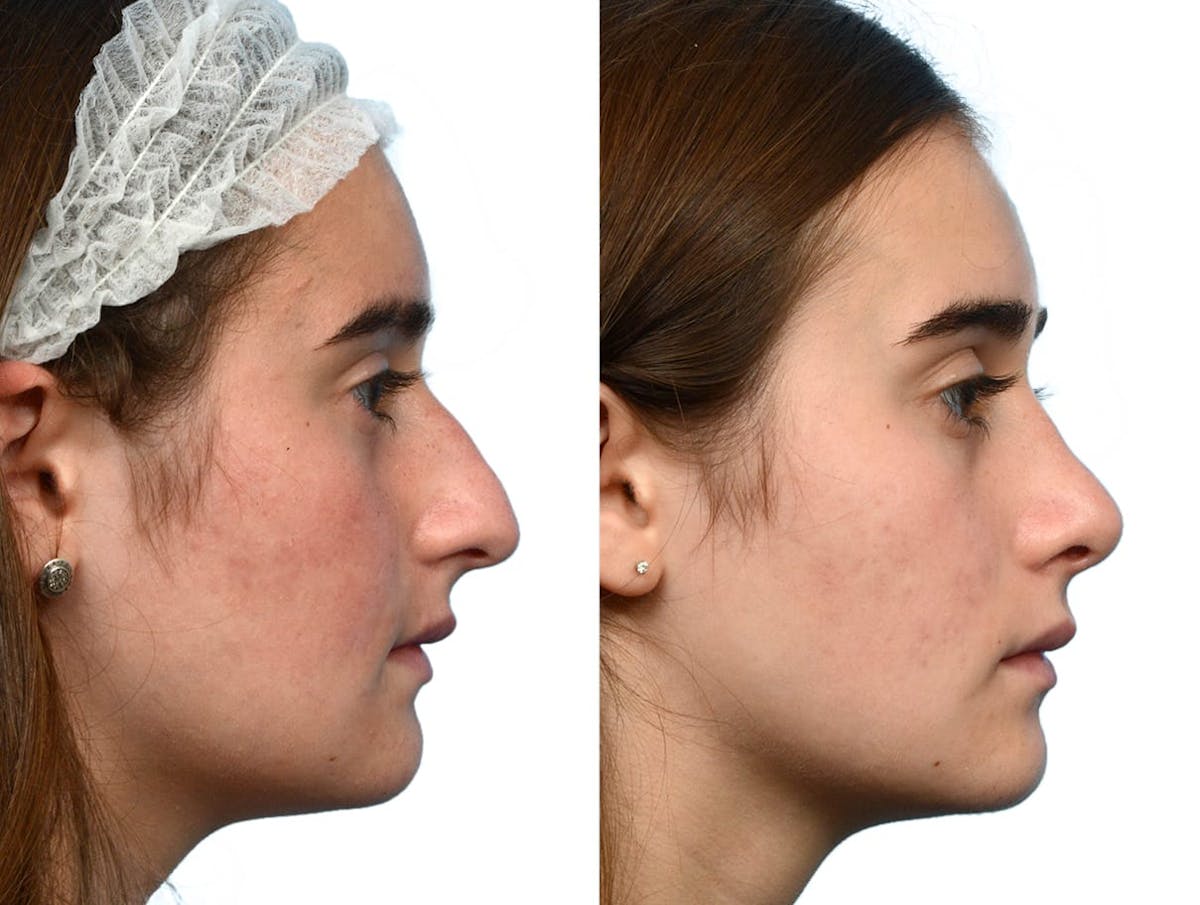 Rhinoplasty Before & After Gallery - Patient 211861 - Image 1