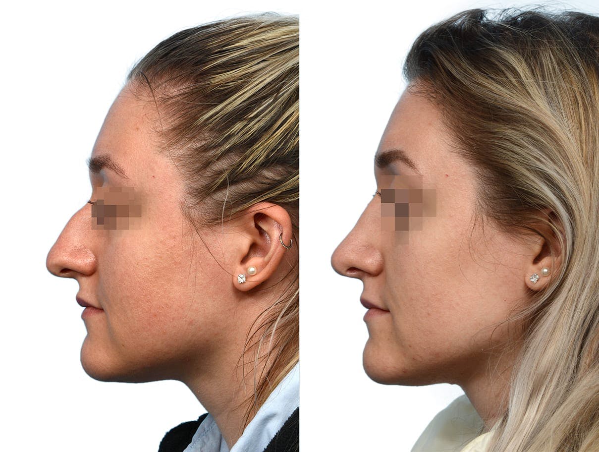 Rhinoplasty Before & After Gallery - Patient 292041 - Image 2