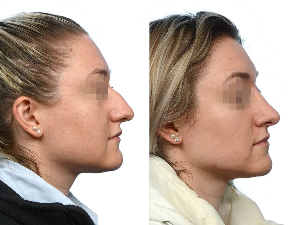 Rhinoplasty Before & After Gallery - Patient 292041 - Image 1