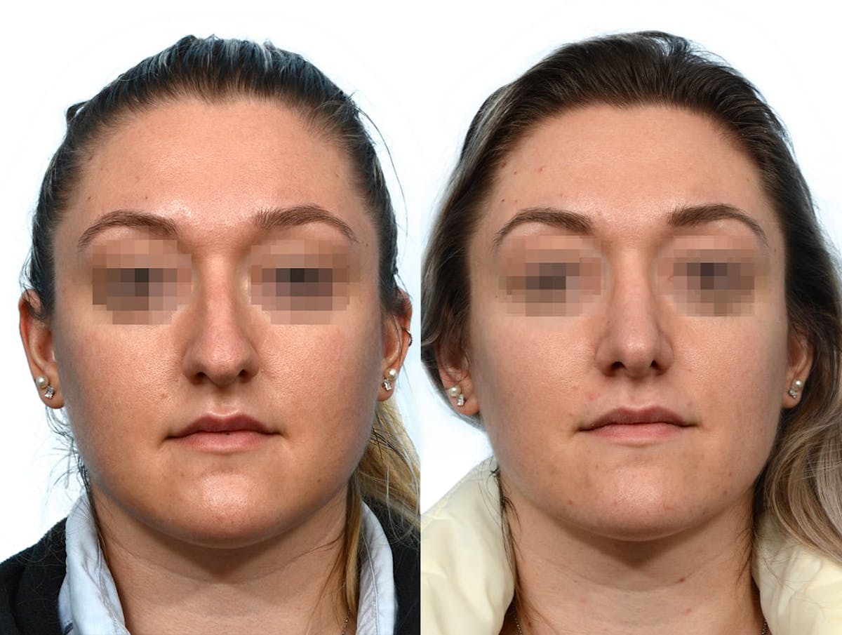 Rhinoplasty Before & After Gallery - Patient 292041 - Image 3