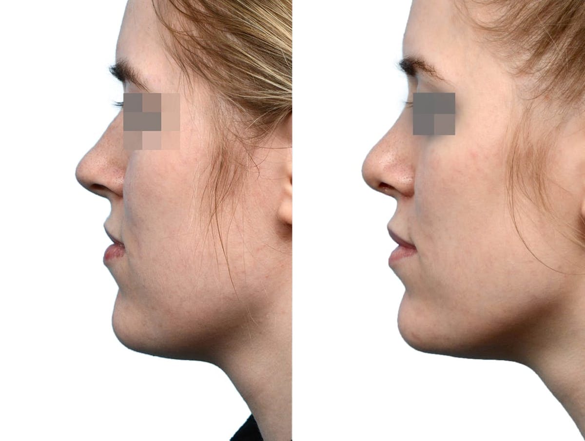 Rhinoplasty Before & After Gallery - Patient 101879 - Image 1