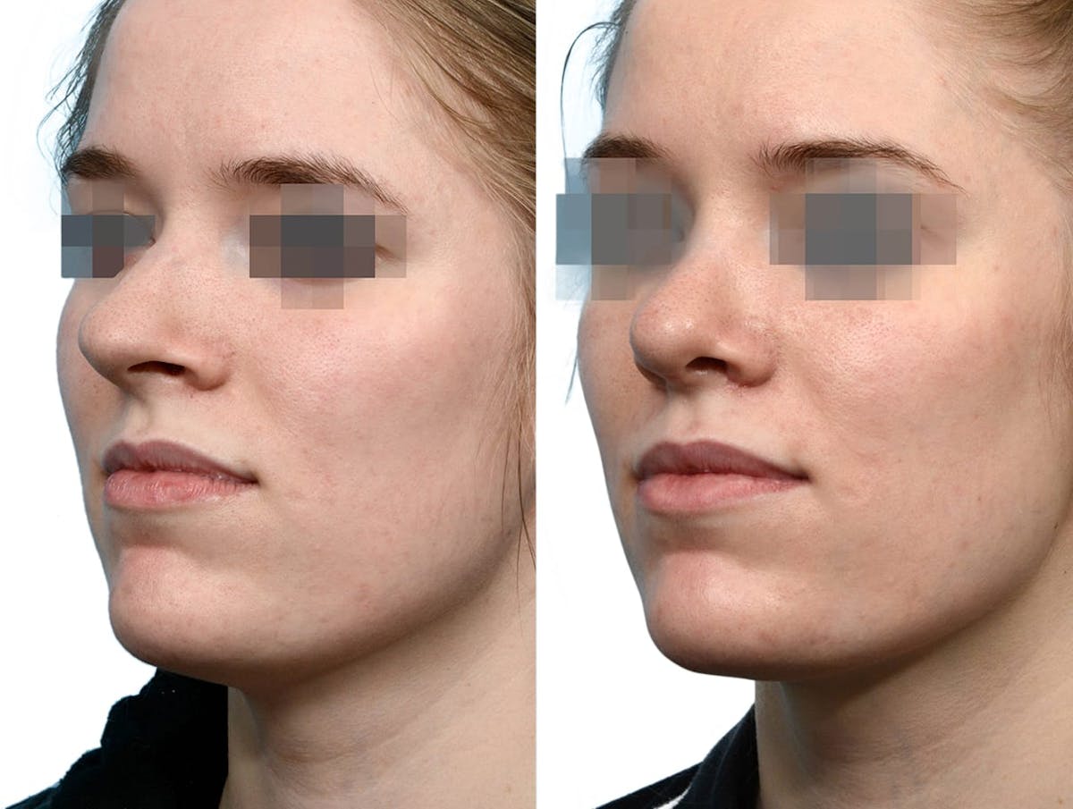 Rhinoplasty Before & After Gallery - Patient 101879 - Image 2