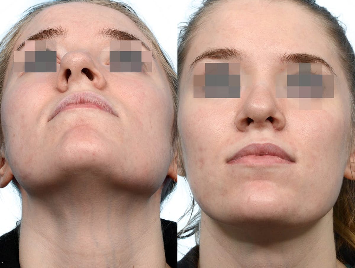 Rhinoplasty Before & After Gallery - Patient 101879 - Image 4