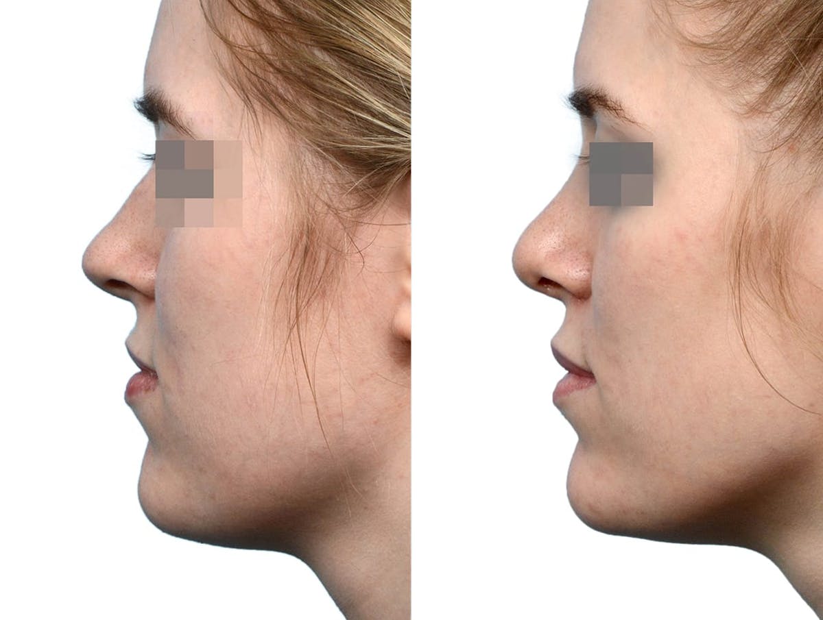 Rhinoplasty Before & After Gallery - Patient 101879 - Image 5