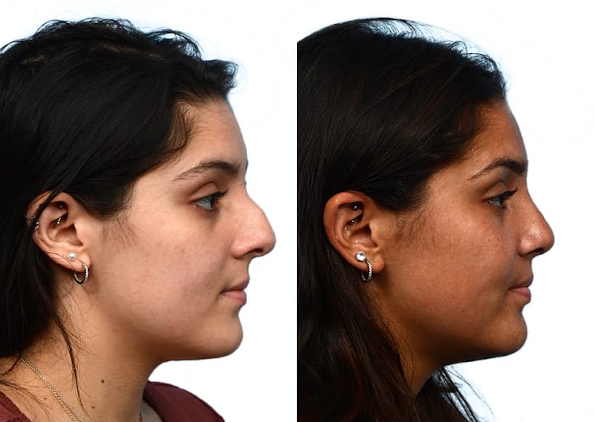 Rhinoplasty Before & After Gallery - Patient 877758 - Image 1