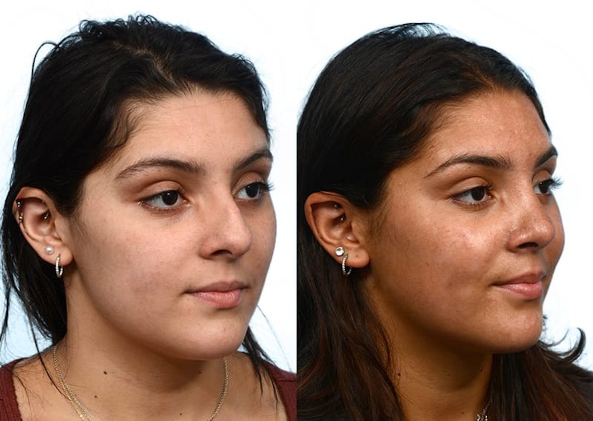 Rhinoplasty Before & After Gallery - Patient 877758 - Image 2