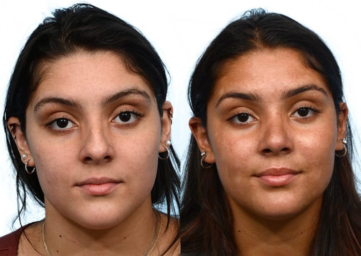 Rhinoplasty Before & After Gallery - Patient 877758 - Image 3