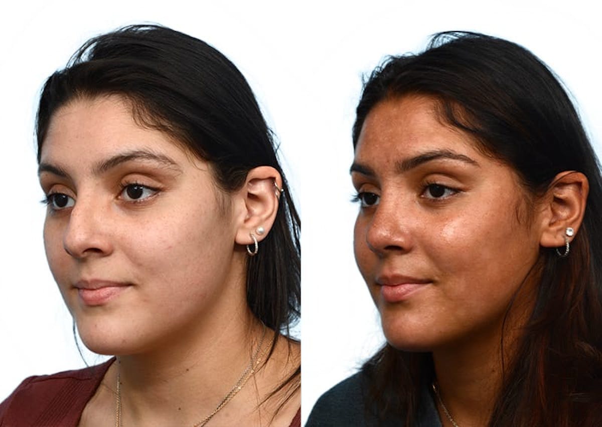 Rhinoplasty Before & After Gallery - Patient 877758 - Image 4
