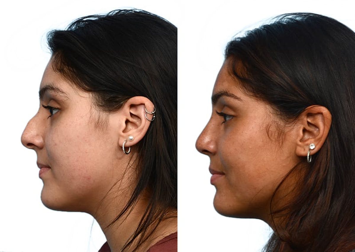 Rhinoplasty Before & After Gallery - Patient 877758 - Image 5