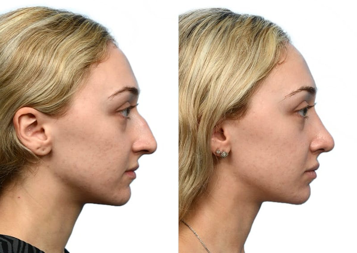 Rhinoplasty Before & After Gallery - Patient 236359 - Image 1
