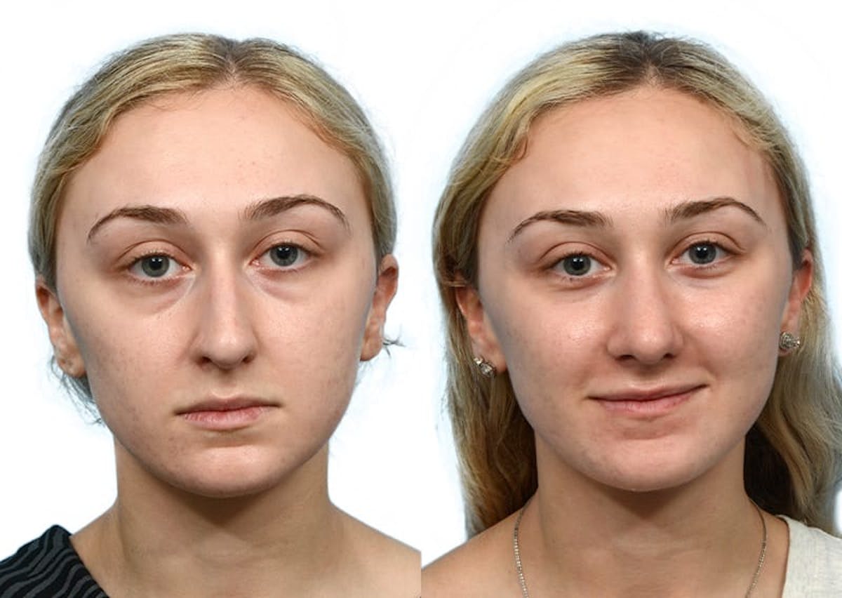 Rhinoplasty Before & After Gallery - Patient 236359 - Image 2