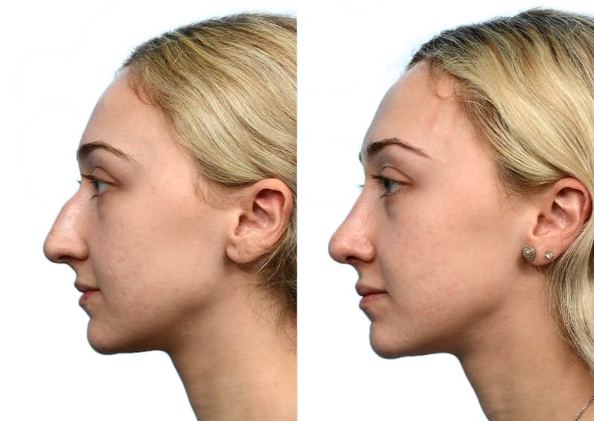 Rhinoplasty Before & After Gallery - Patient 236359 - Image 3