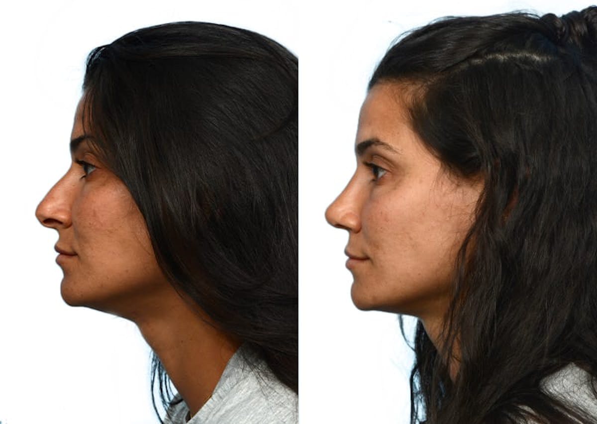 Rhinoplasty Before & After Gallery - Patient 413549 - Image 2
