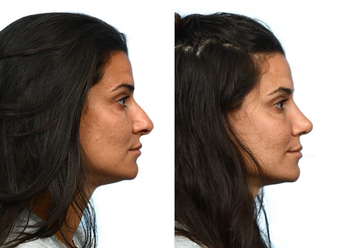 Rhinoplasty Before & After Gallery - Patient 413549 - Image 1
