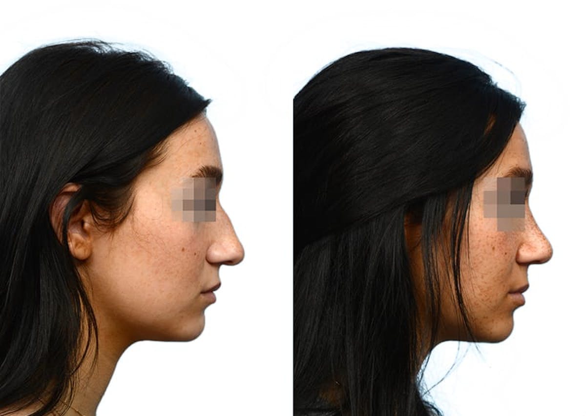 Rhinoplasty Before & After Gallery - Patient 322727 - Image 1