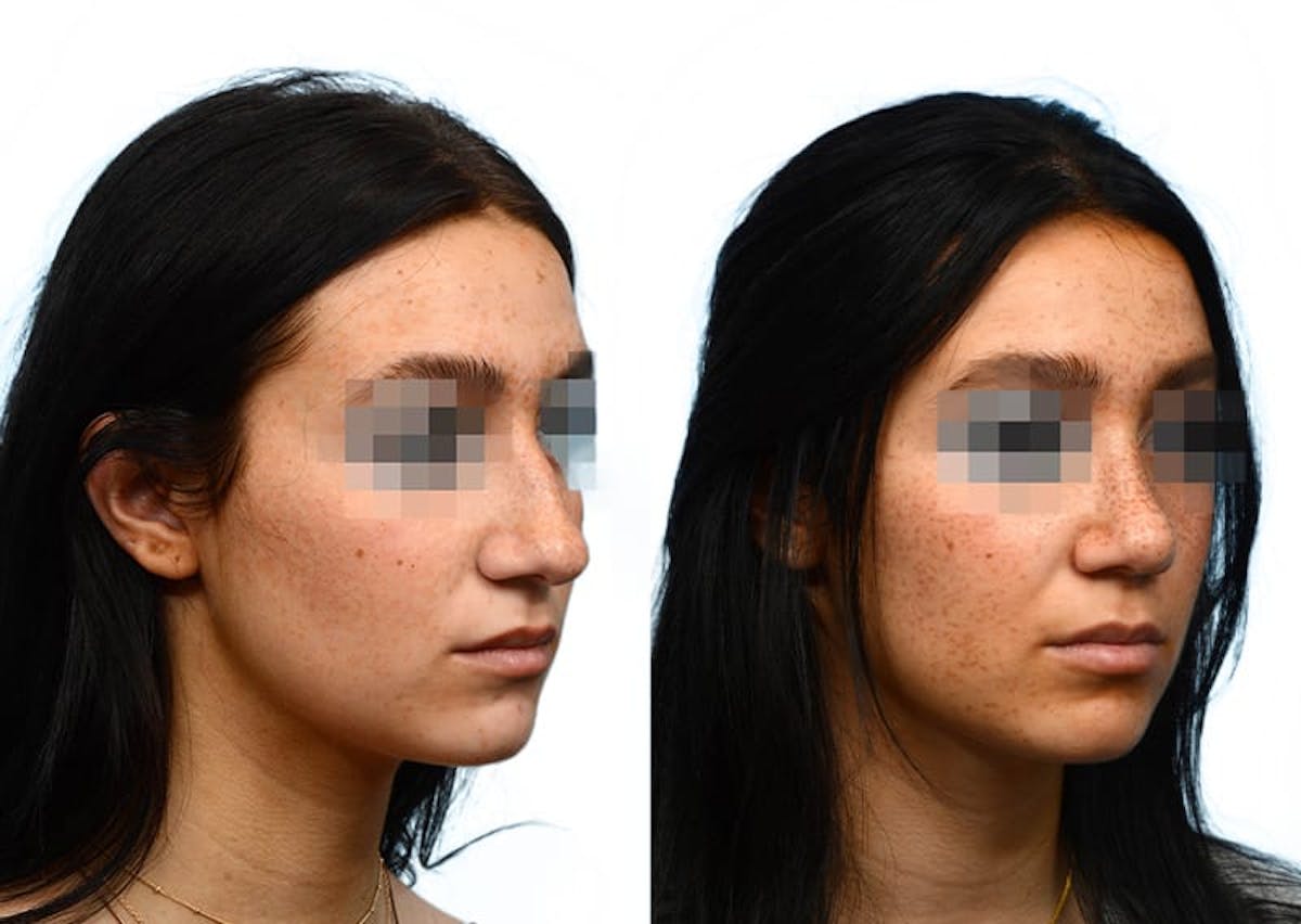 Rhinoplasty Before & After Gallery - Patient 322727 - Image 2