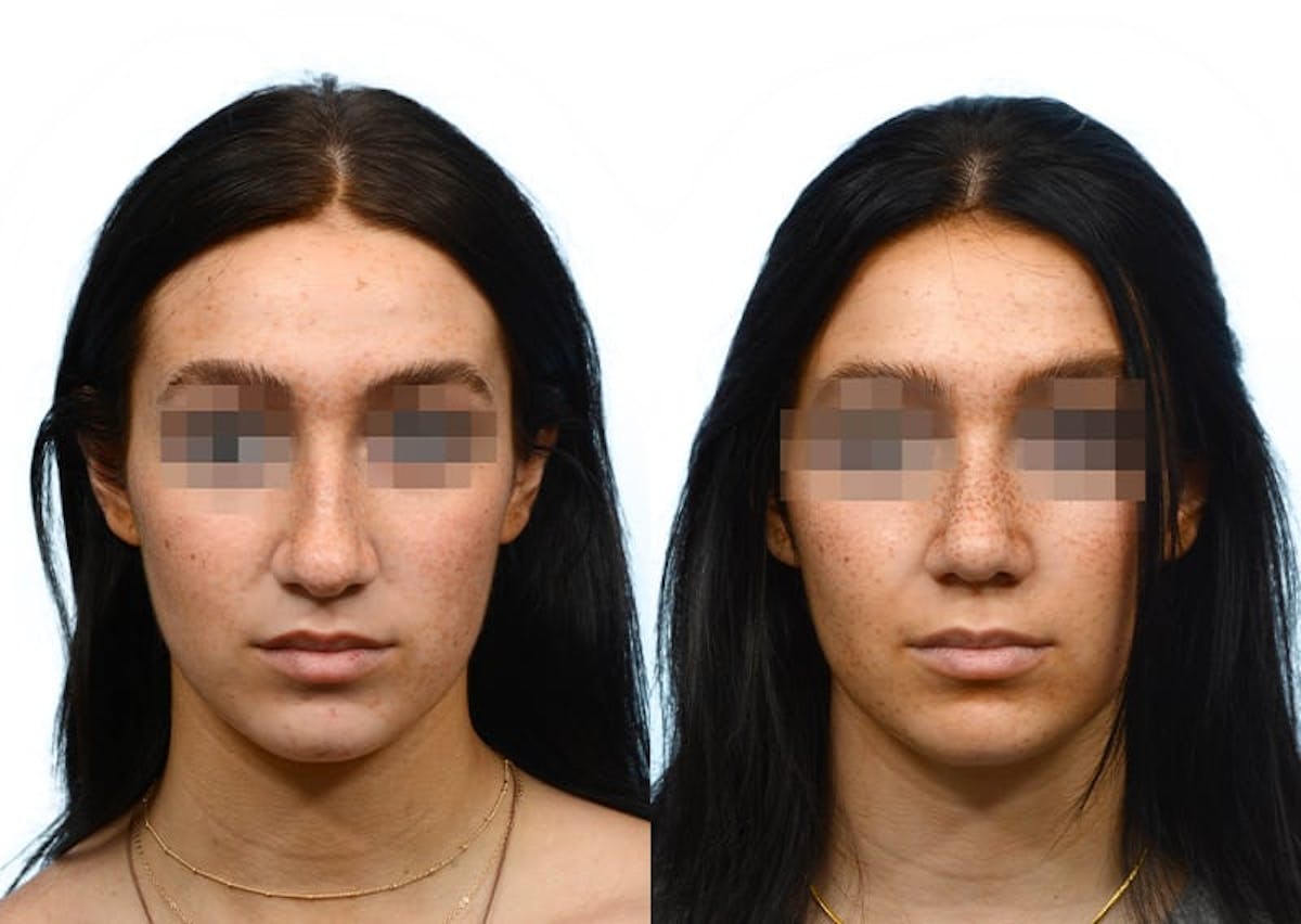 Rhinoplasty Before & After Gallery - Patient 322727 - Image 3