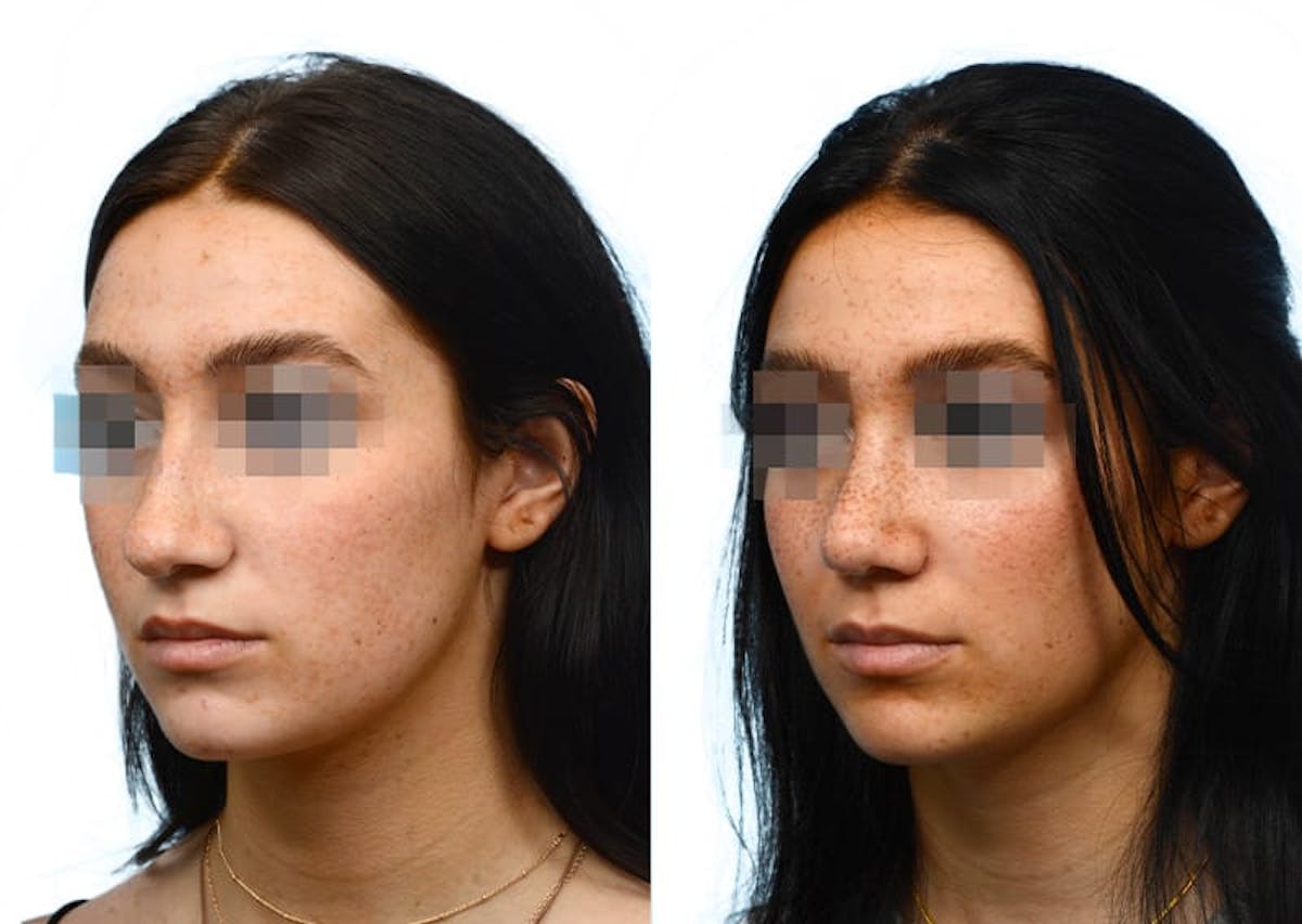 Rhinoplasty Before & After Gallery - Patient 322727 - Image 4