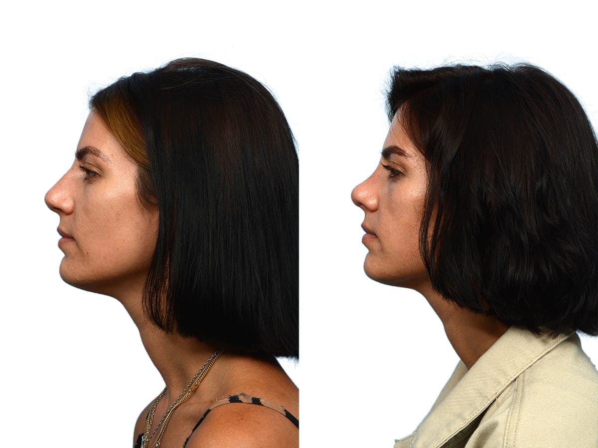 Rhinoplasty Before & After Gallery - Patient 104428 - Image 1