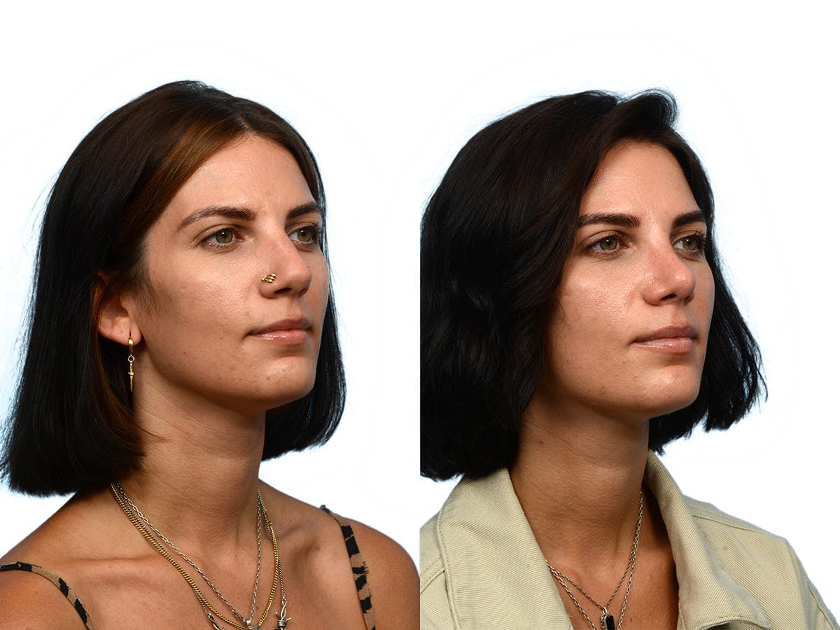 Rhinoplasty Before & After Gallery - Patient 104428 - Image 2