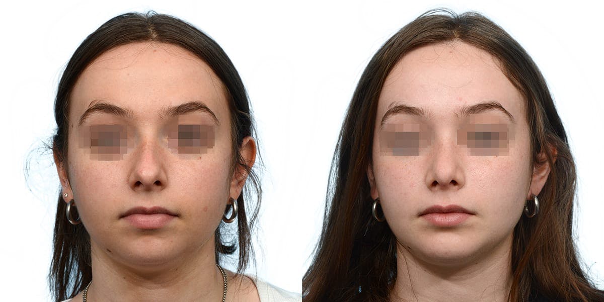 Rhinoplasty Before & After Gallery - Patient 369128 - Image 2