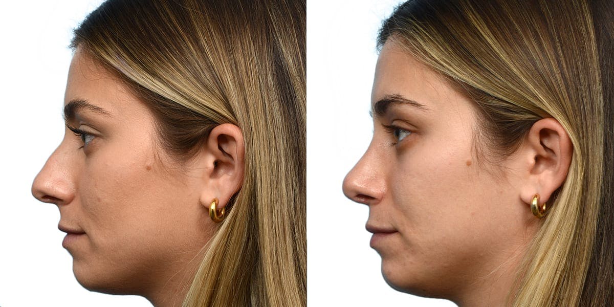 Rhinoplasty Before & After Gallery - Patient 137914 - Image 2