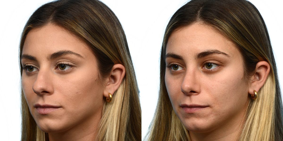 Rhinoplasty Before & After Gallery - Patient 137914 - Image 3