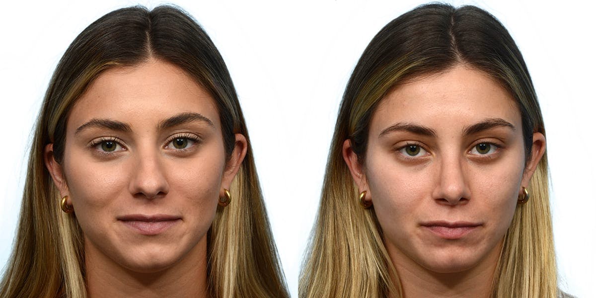 Rhinoplasty Before & After Gallery - Patient 137914 - Image 4