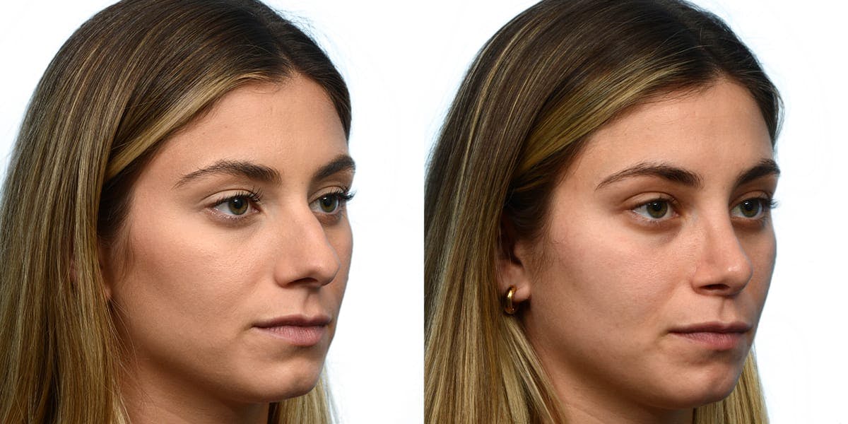 Rhinoplasty Before & After Gallery - Patient 137914 - Image 5