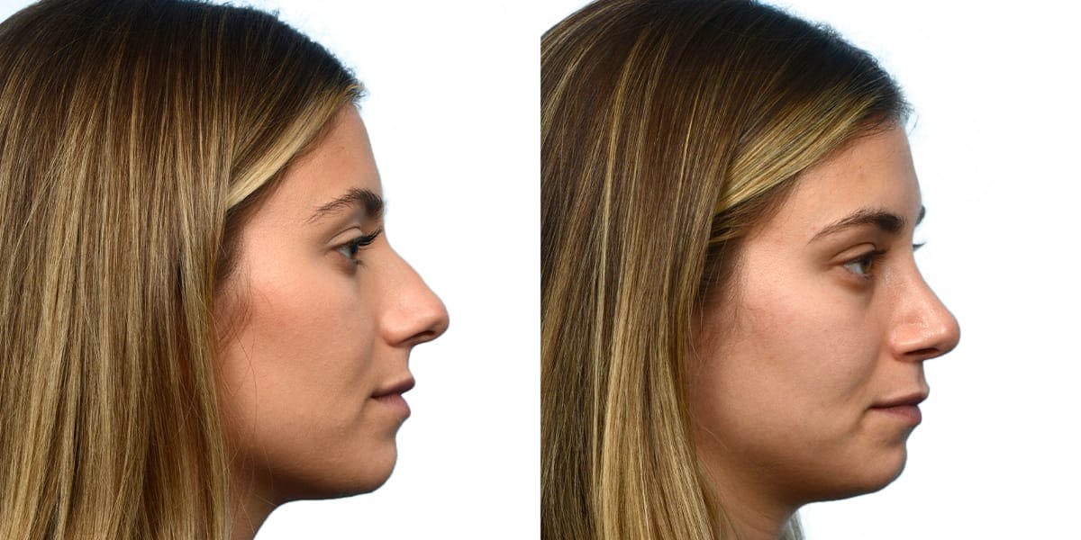 Rhinoplasty Before & After Gallery - Patient 137914 - Image 1