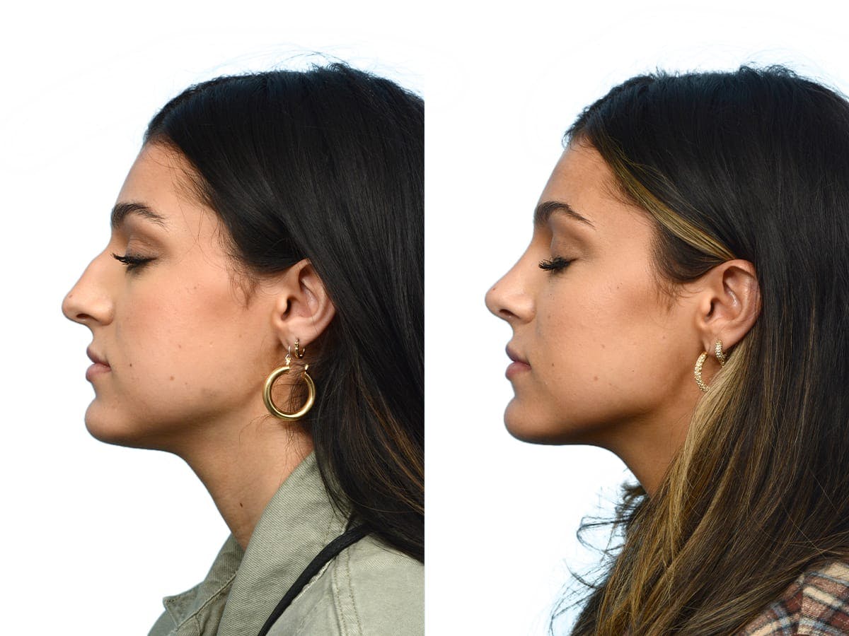 Rhinoplasty Before & After Gallery - Patient 395596 - Image 2